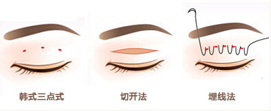 双眼皮,长春好的整形医院