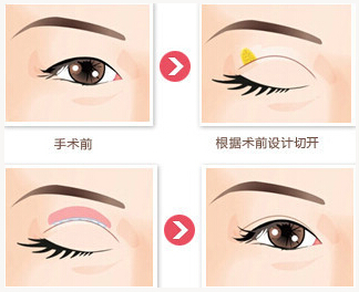 双眼皮,长春好的整形医院