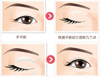 双眼皮,长春好的整形医院