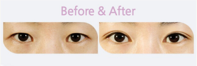 双眼皮,对比图,长春好的整形医院
