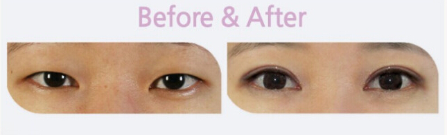 双眼皮,对比图,长春好的整形医院