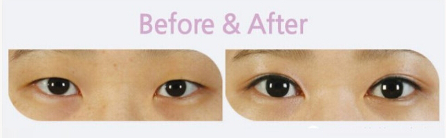 双眼皮,对比图,长春好的整形医院
