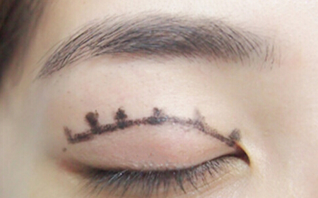 双眼皮,埋线,过程,吉林铭医