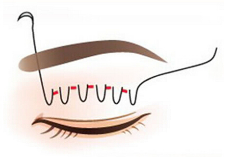 双眼皮,埋线,过程,吉林铭医