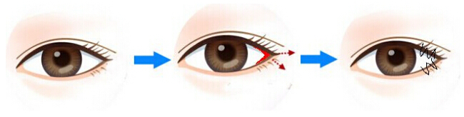 开眼角,长春双眼皮,长春好的整形医院