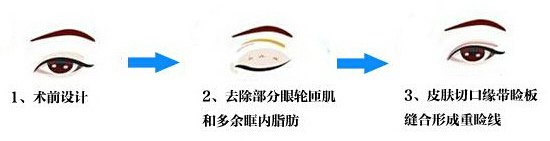 开眼角,长春双眼皮,长春好的整形医院