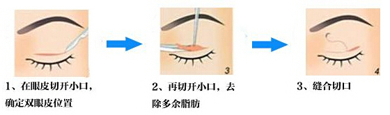 开眼角,长春双眼皮,长春好的整形医院
