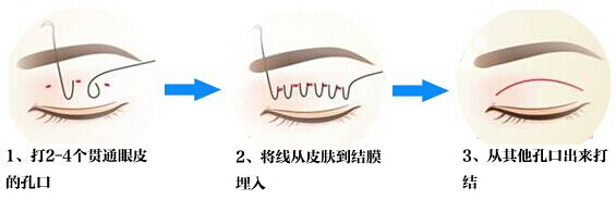 开眼角,长春双眼皮,长春好的整形医院