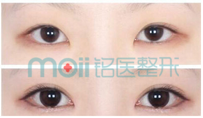 长春双眼皮,埋线,相对比,长春好的整形医院