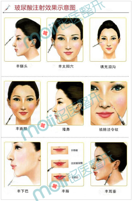 玻尿酸,作用部位,效果,示意图,长春好的整形医院