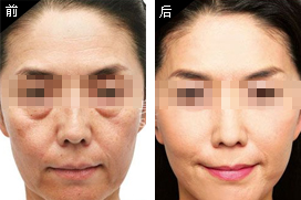 内窥镜除皱术让你更年轻