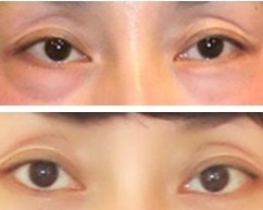 祛眼袋手术疗效至少可以持续多少年？