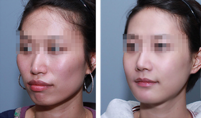 玻尿酸注射3部位 效果有差异