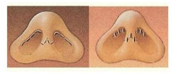 鼻综合整形,图解,长春好的整形医院