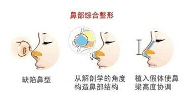鼻综合整形,图解,长春好的整形医院