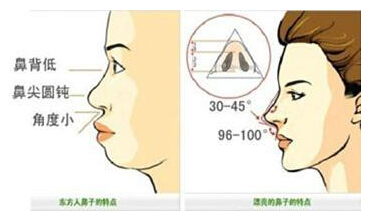 鼻综合整形,图解,长春好的整形医院
