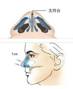 鼻综合整形,图解,长春好的整形医院