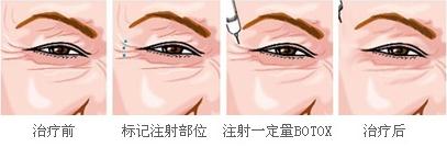 BOTOX,注射,除皱,长春好的整形医院