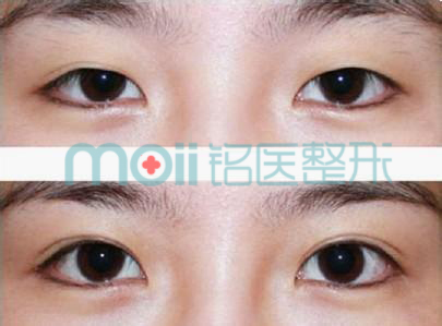 双眼皮,对比图,长春好的整形医院