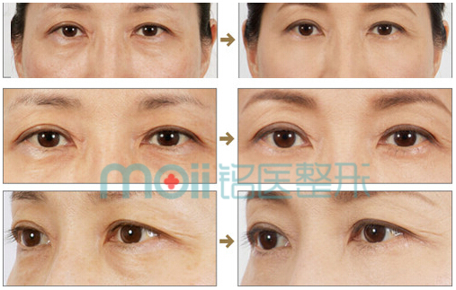 眼部,细纹,玻尿酸,对比图,长春好的整形医院