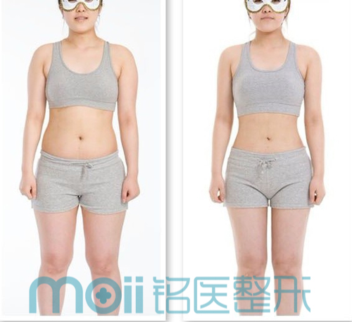 抽脂,对比图,长春好的整形医院