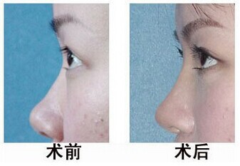 玻尿酸隆鼻 让你向塌鼻子说拜拜