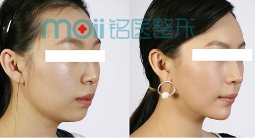玻尿酸,隆鼻,丰下巴,对比图,长春好的整形医院