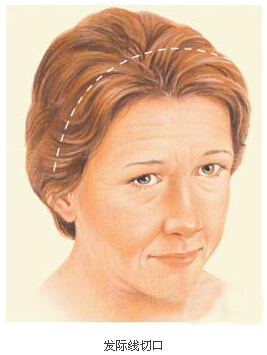 拉皮,切口,长春好的整形医院