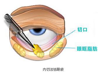 眼袋,切口,长春好的整形医院