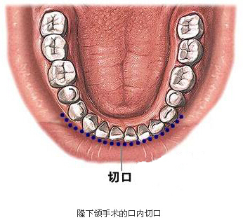 磨骨,切口,长春好的整形医院
