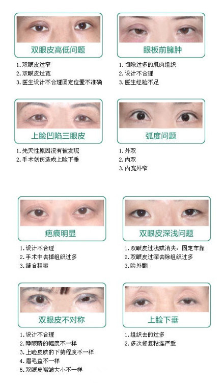 双眼皮,手术失败,8种表现,长春好的整形医院