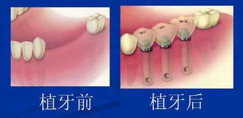 种植牙,对比图,长春好的整形医院