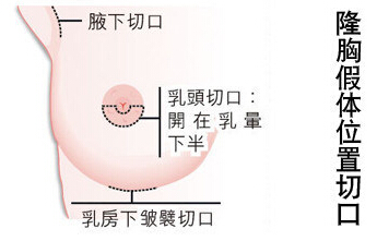 隆胸,哺乳,乳腺,乳腺导管,长春好的整形医院