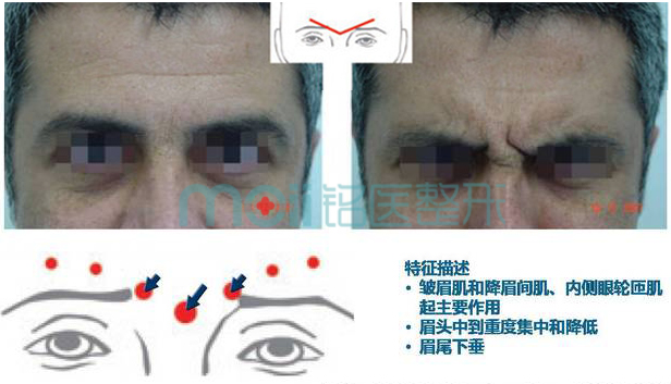 皱眉纹类型,V型,长春好的整形医院
