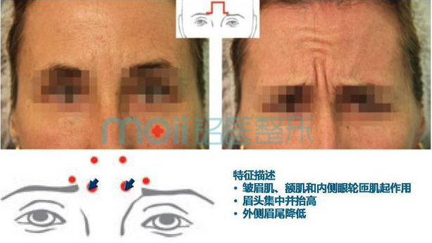 皱眉纹类型,Ω型,长春好的整形医院