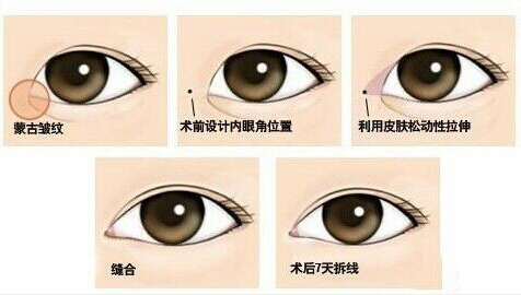 开内眼角,过程,长春好的整形医院