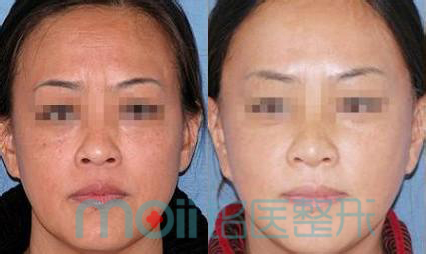 眉间纹,肉毒素,对比图,长春好的整形医院