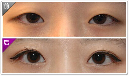 双眼皮,对比图,长春好的整形医院