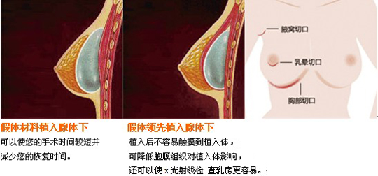 假体硅胶,隆胸,长春好的整形医院