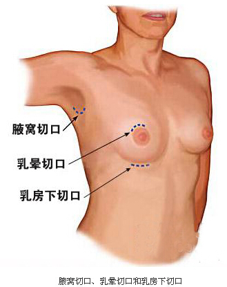 假体隆胸,切口,长春好的整形医院