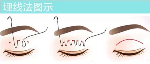 埋线,双眼皮,长春好的整形医院