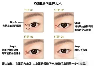 Z成形法,开眼角,示意图,长春好的整形医院