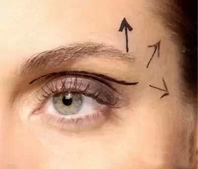 开外眼角,内外眼角,区别,长春好的整形医院