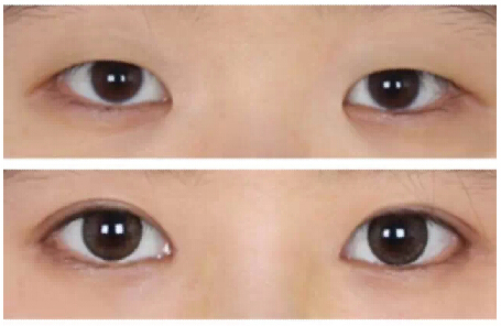 开内眼角,对比图,长春好的整形医院