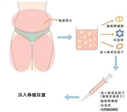 隆鼻材料,自体脂肪,长春好的整形医院
