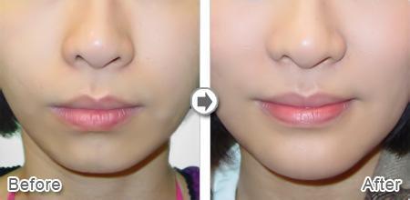 隆下巴,对比图,长春好的整形医院