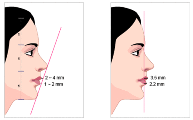 隆下巴,对比图,长春好的整形医院