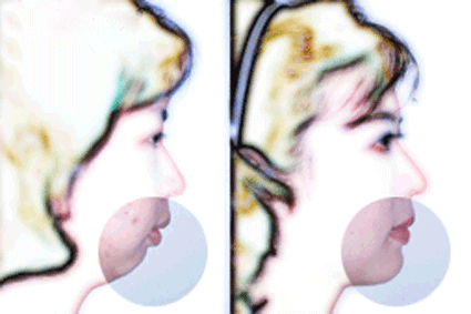 隆下巴,对比图,长春好的整形医院