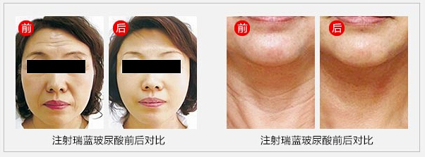 玻尿酸,瑞蓝,对比图,长春好的整形医院