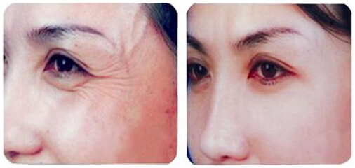 鱼尾纹,对比图,长春好的整形医院